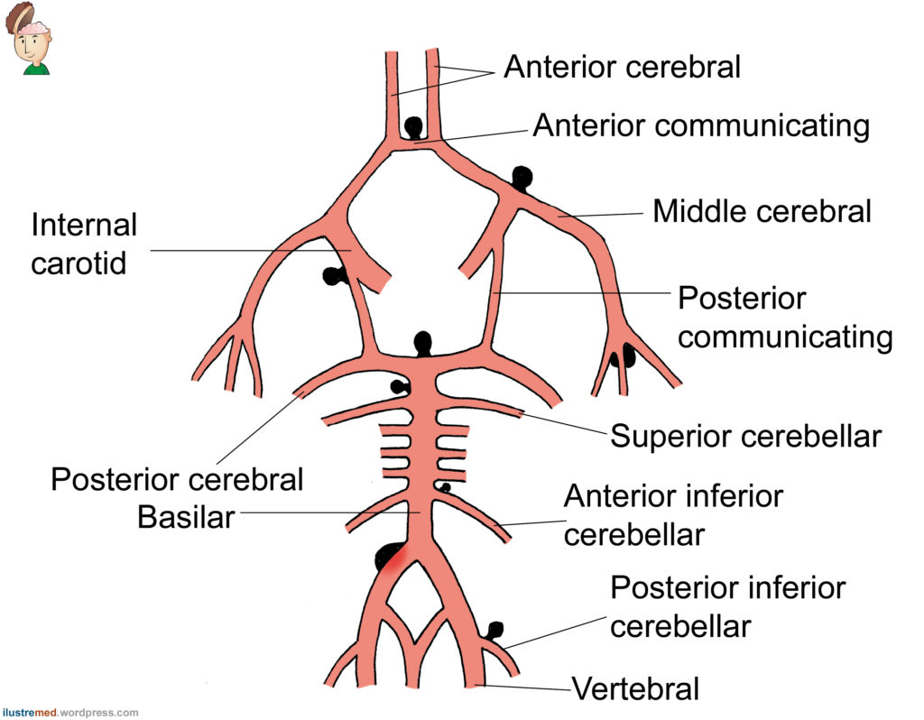 O Que Aneurisma Cerebral E Como Tratar Neurocirurgi O S O Paulo